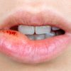 Orale Lippen Herpes Infektion, / Lippe aufgebissen