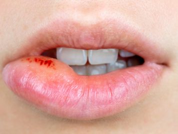 Lippenherpes: So werden Sie die Ekel-Bläschen schnell wieder los Orale Lippen Herpes Infektion, / Lippe aufgebissen
