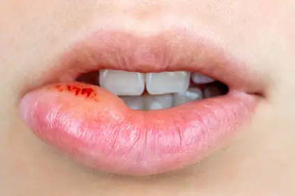 Orale Lippen Herpes Infektion, / Lippe aufgebissen